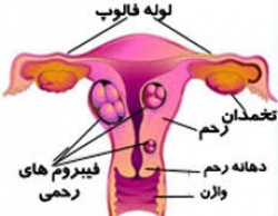 فیبرم رحمی