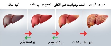 کبد چرب
